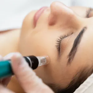 Microneedling